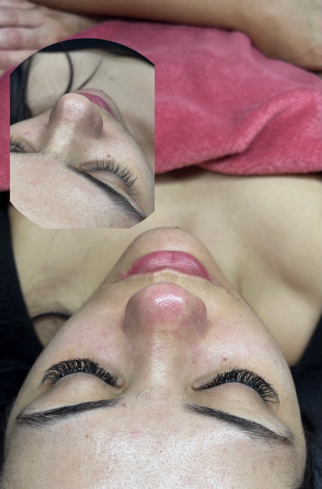 Limpeza de pele, antes e depois